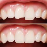 باندینگ برای ترمیم شکستگی